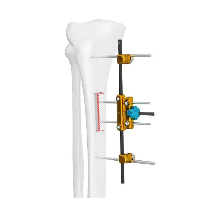Double Medical horizontal transport fixator